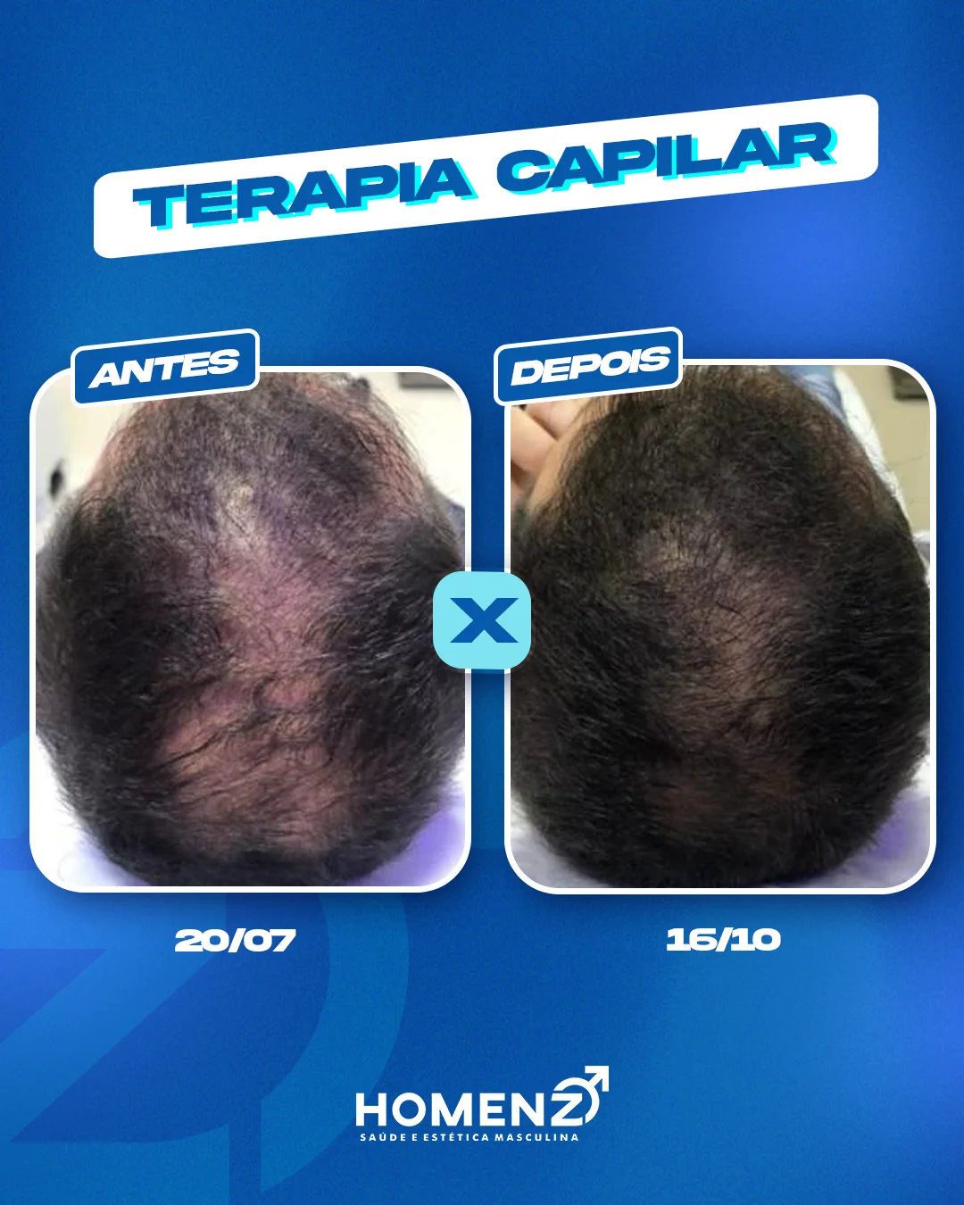 Antes e depois terapia capilar