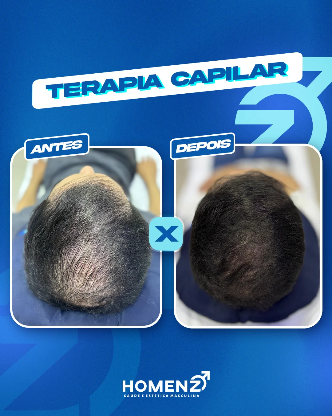Antes e depois terapia capilar