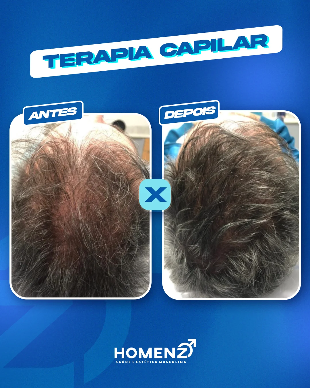 Antes e depois terapia capilar