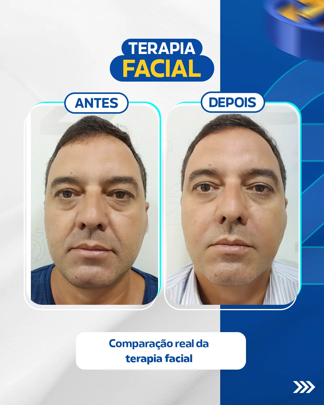 Comparação real da terapia facial