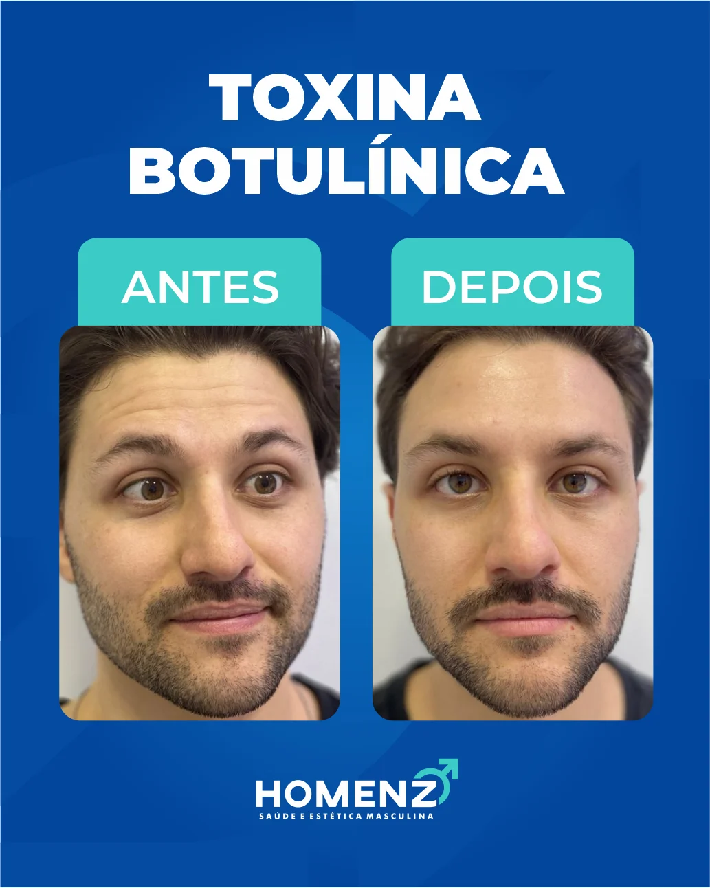 Antes e depois toxina botulínica