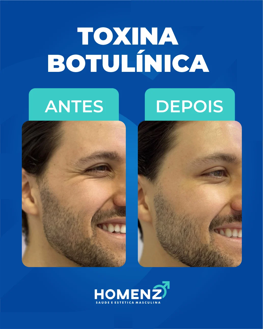 Antes e depois toxina botulínica